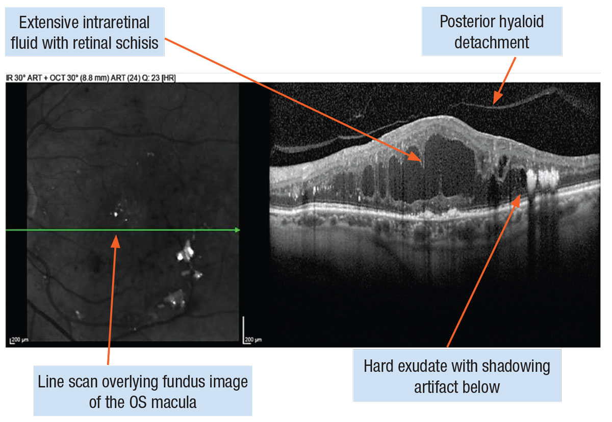 Vitrectomy may have a protective effect on DME, study findings suggest.