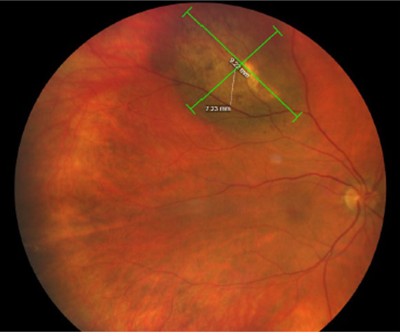 One finding from this new study was that anteriorly located tumors may increase IOP earlier on.