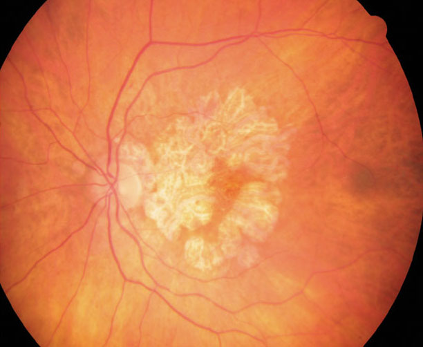 RPE cells from GA patients show constitutive differences in visual cycle processes and melanosome function.