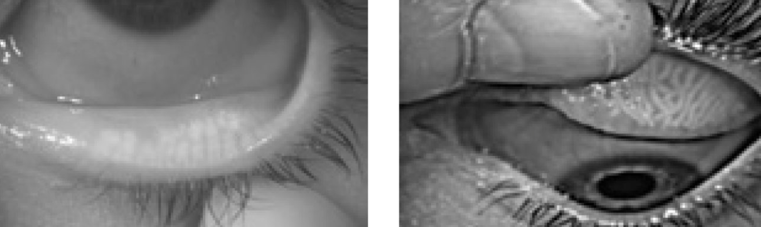 Contact lens discomfort may be due in part to meibomian morphology changes.