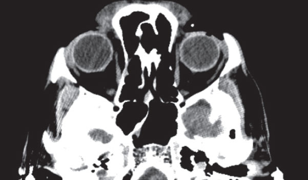 CT scans can help predict visual outcomes among traumatic eye injury patients.