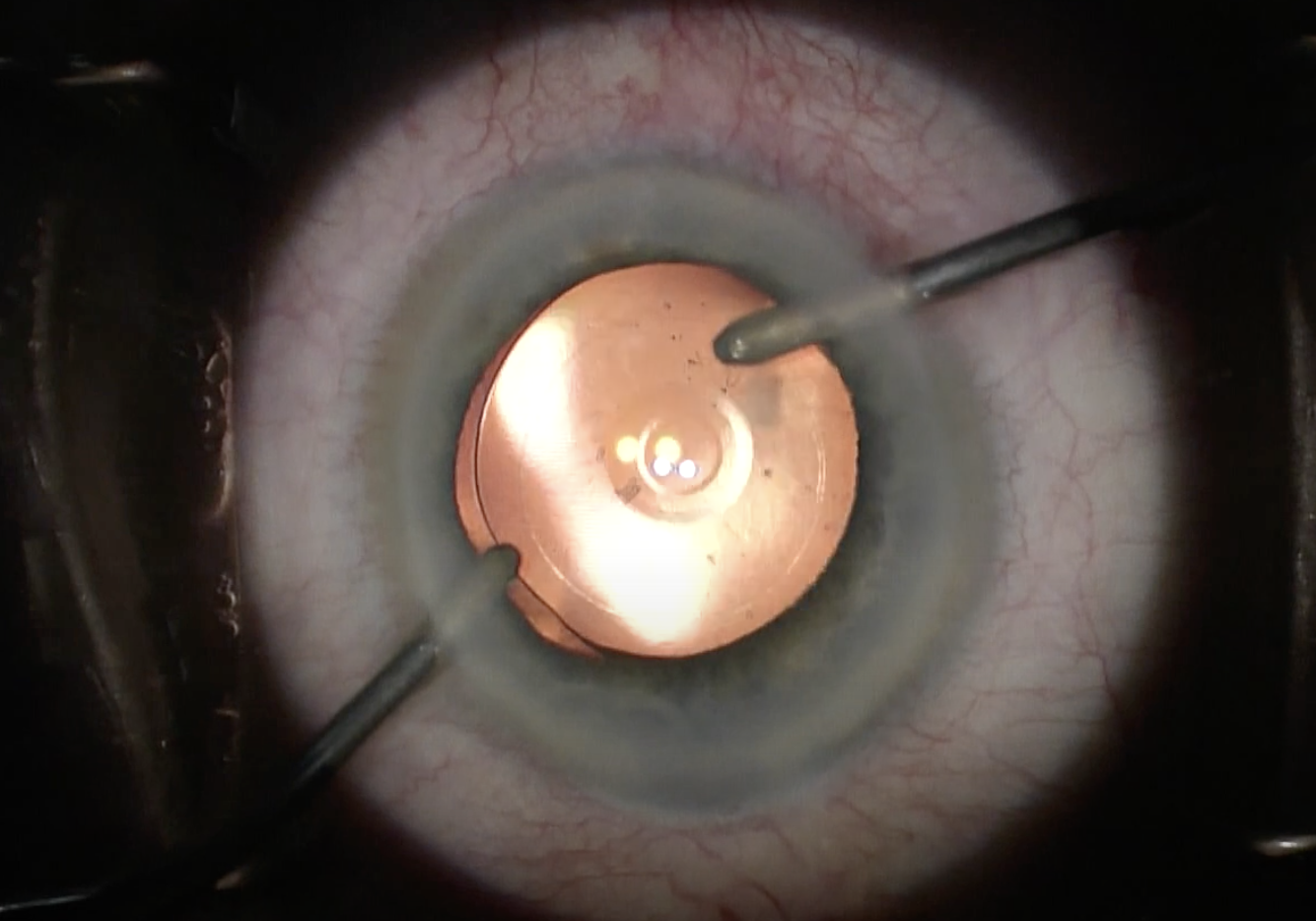 IOL clarity may fluctuate due to hypotensive drug use.