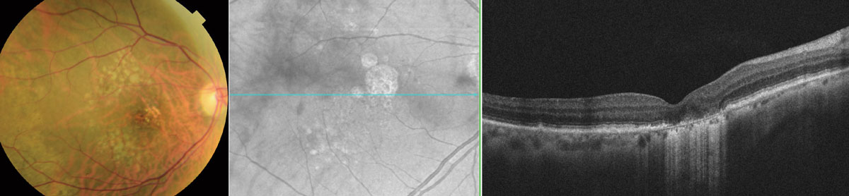 The presence of nascent GA serves as a significant risk factor for progression.