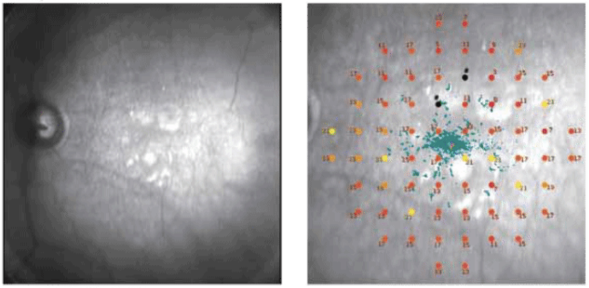 Microperimetry may help pinpoint risk of AMD progression.