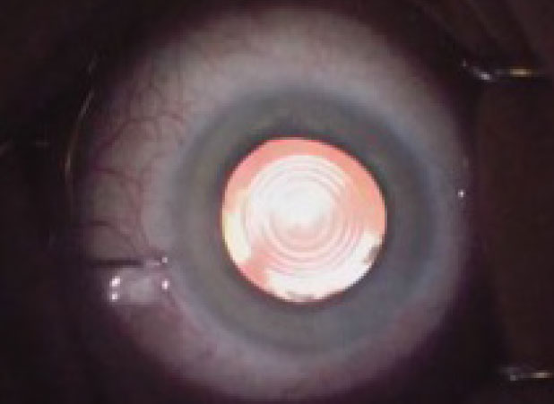 When ranked with other multifocal IOLs, trifocals came out on top for VA outcomes in presbyopia.