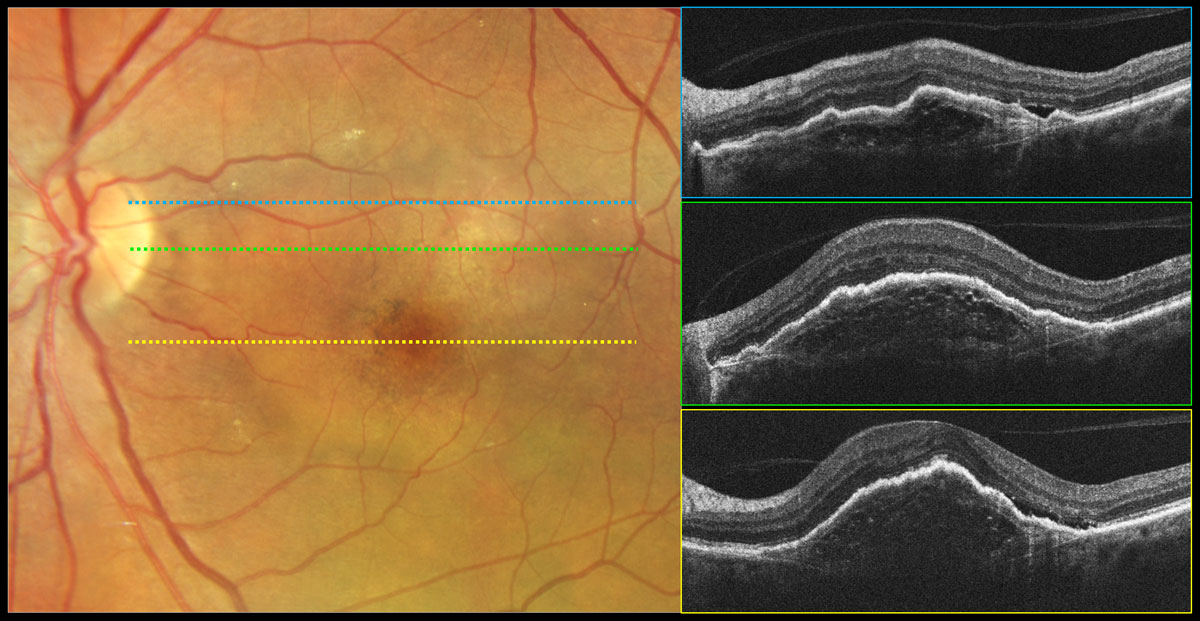 Beware of fibrotic scar when imaging nAMD patients, as fibrosis is known as one of the condition’s end-stage—and vision-threatening—sequelae.