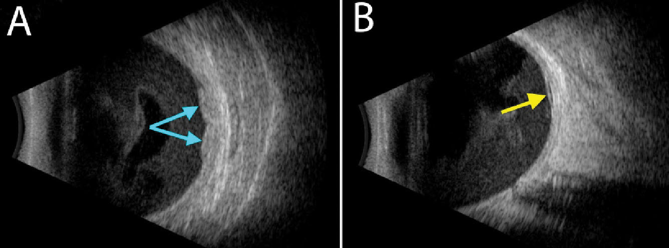 Ultrasonography shows a hyperechoic, lobular and solid-appearing area of subretinal thickening (A, blue arrows) with an adjacent small pocket of subretinal fluid (B, yellow arrow). Diffuse hemorrhage can be seen in the vitreous cavity in both images.