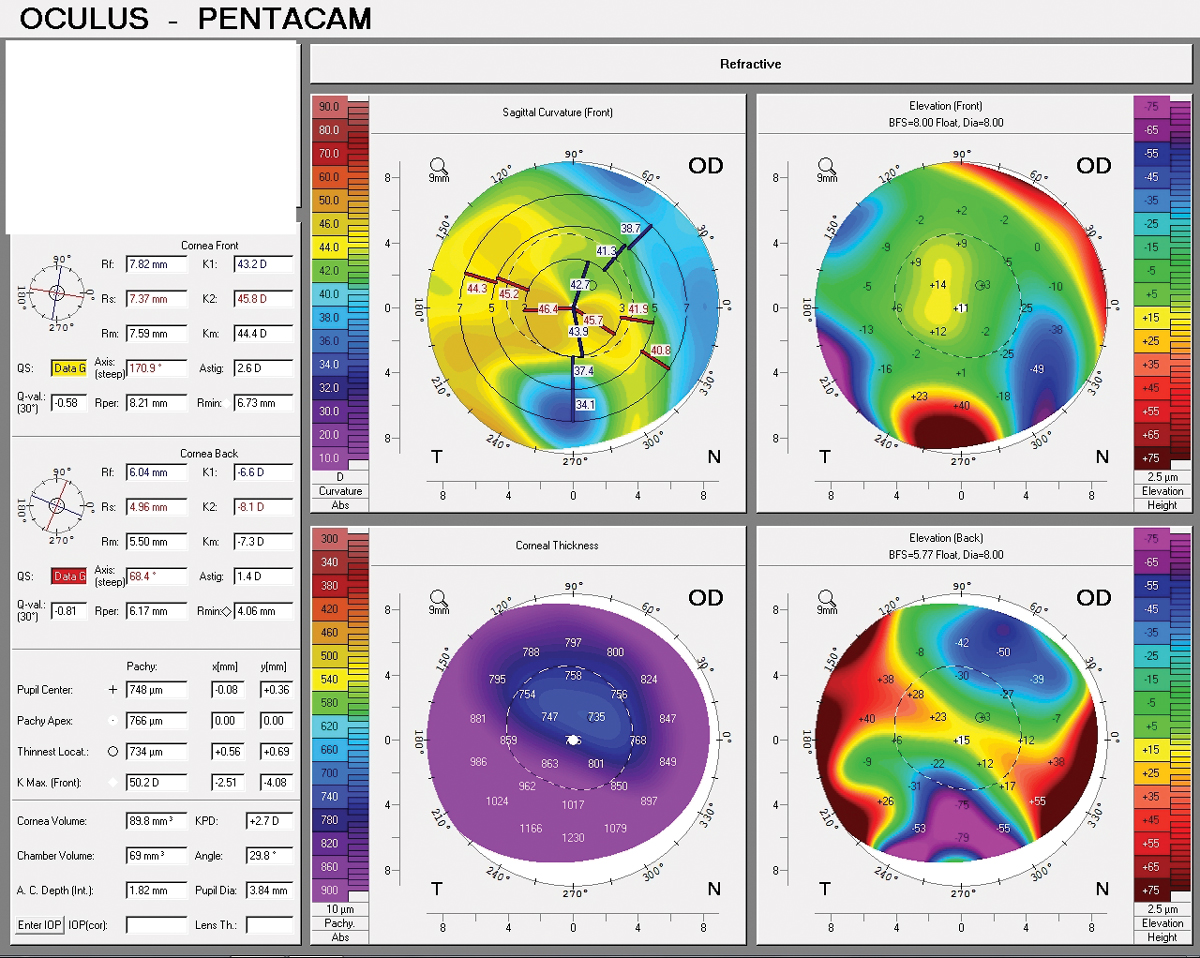 Pentacam of a post-LASIK inferior Salzmann’s nodule, which can only be diagnosed virtually if topography is able to be completed remotely, such as via a mobile testing van.