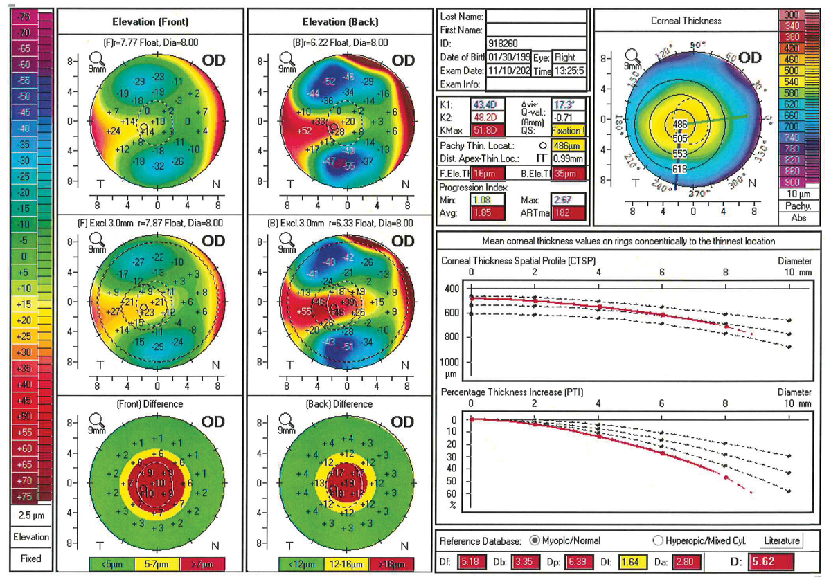 Corneal and scleral lenses fail to significantly alter the posterior corneal surface.