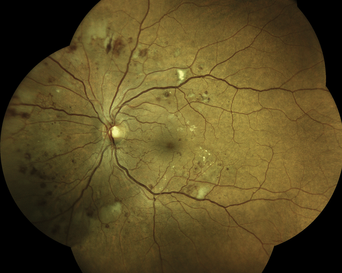 Using an AI system to screen patients with diabetes may have a time-saving advantage over human-based grading.