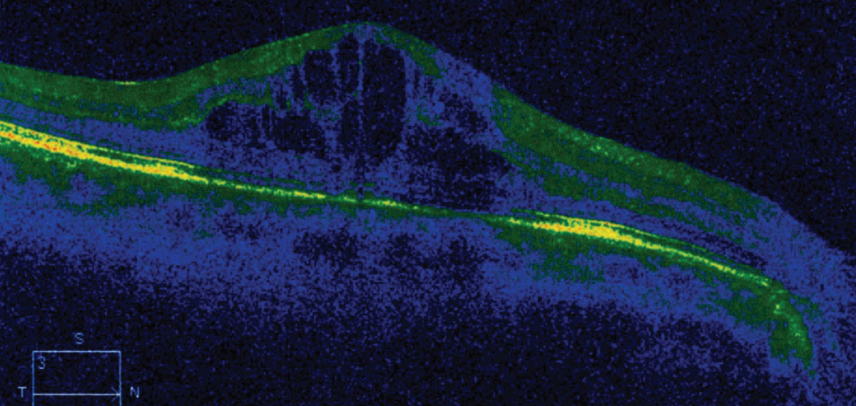 Treating cataract surgery patients postoperatively with NSAIDs and steroids instead of steroids alone was found to increase unplanned visits during the first six months post-op.