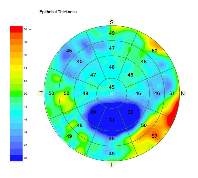 Ectatic diseases such as keratoconus may manifest in the epithelium before other evidence appears.