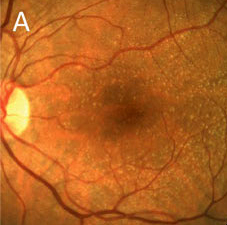 When detecting drusen smaller than 125µm, color fundus photography seems to allow for clearer visualization than OCT, researchers suggest.