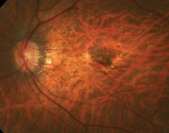 : Among the risk factors for myopic macular neovascularization development are prior neovascularization, patchy atrophy and foveal RD.