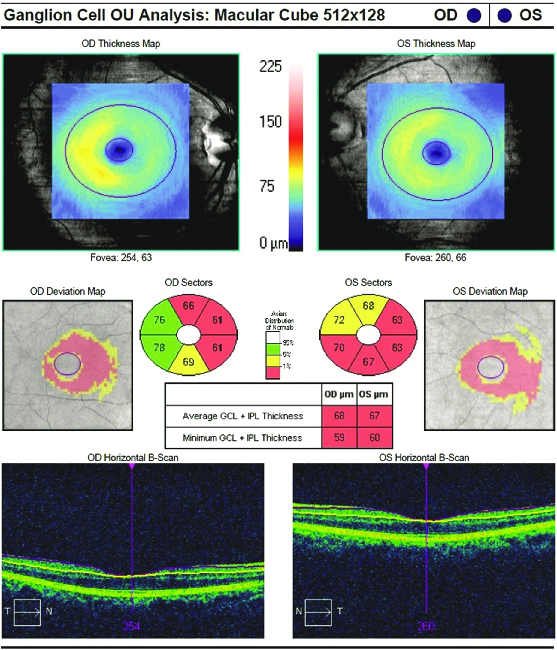 GCL and IPL thinning in an Alzheimer’s patient.