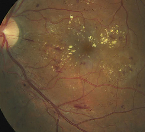 Shorter diabetes duration and thicker central subfield thickness may put patients at greater risk for developing DME in the fellow eye.