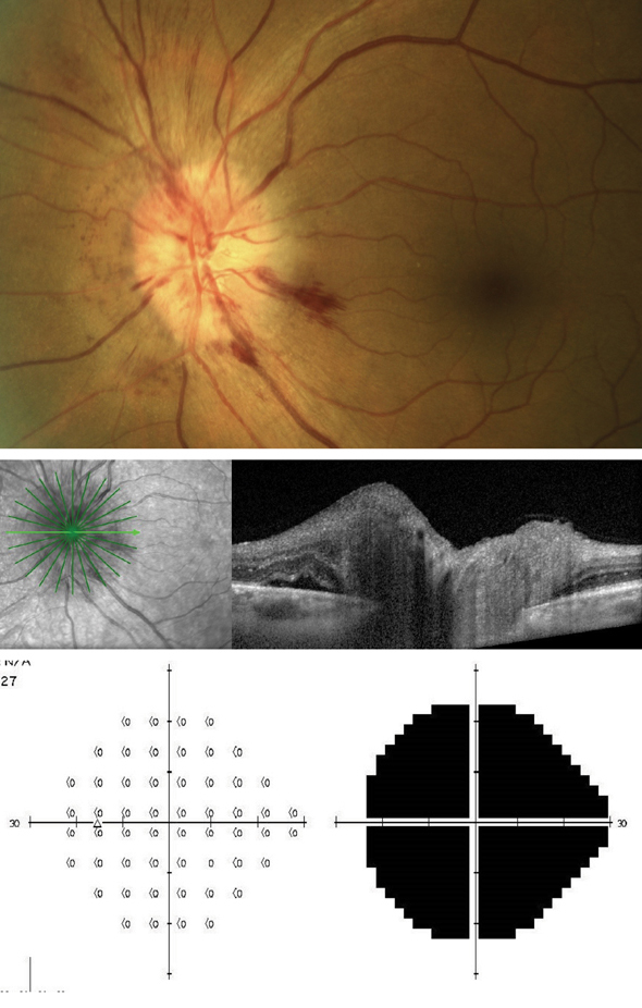 Researchers in this study note that accurately identifying suspected AAION in patients is critical, as untreated giant cell arteritis can carry a high risk of bilateral involvement.