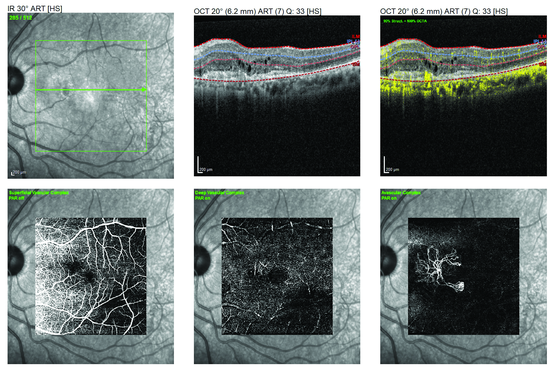 COPD patients show vascular differences on OCT-A.