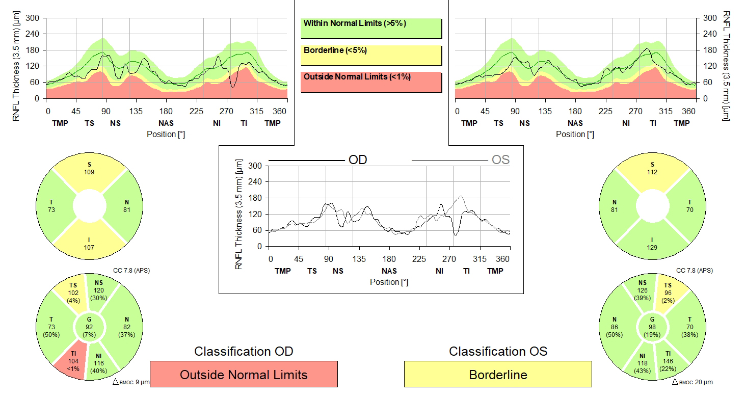 Higher IOP variability was independently associated with RNFL thinning rate in patients with glaucoma. 