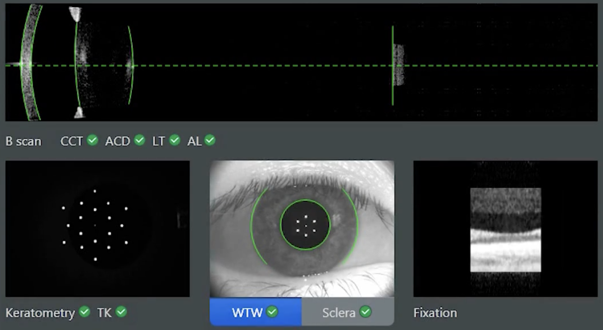 Diurnal rhythms in ocular biometry appear to be synchronized with melatonin secretion in both winter and summer.