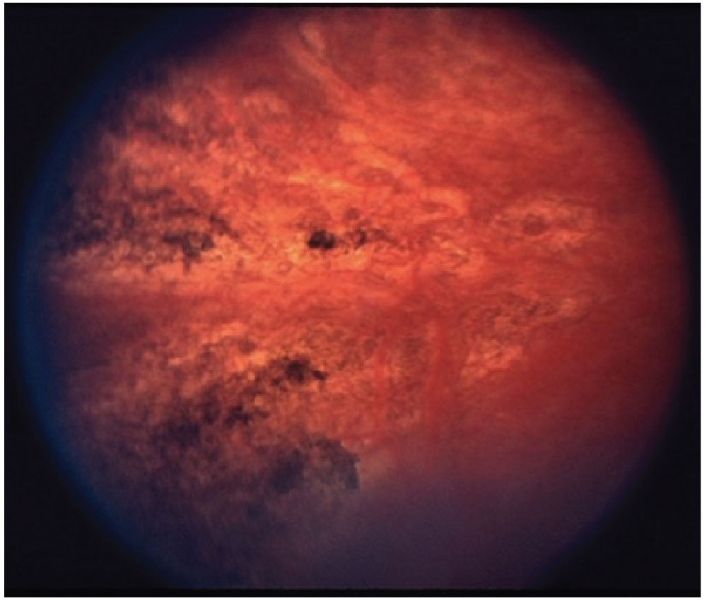 Fig. 2. Siegrist streaks, a rare manifestion of hypertensive choroidopathy.