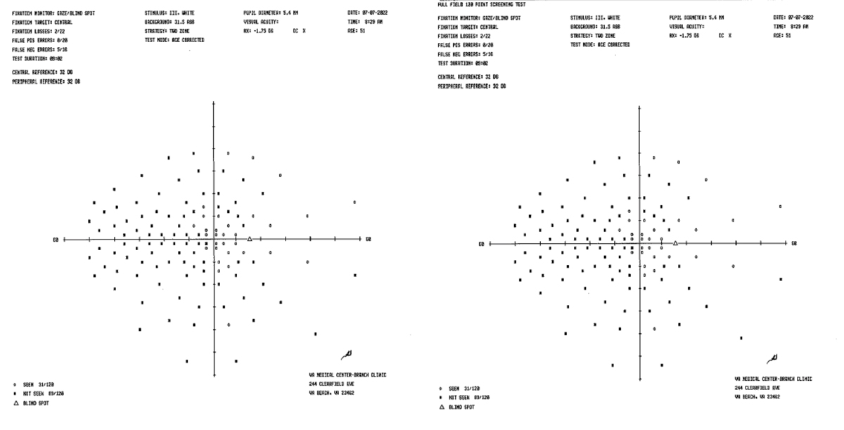 Fig. 2. Humphrey visual field analysis with 120-point screen demonstrating a left-sided homonymous hemianopia visual field defect secondary to ischemic stroke from COVID-19. 