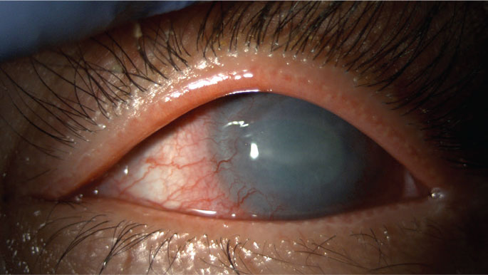 Clinical presentation of Acanthamoeba keratitis.