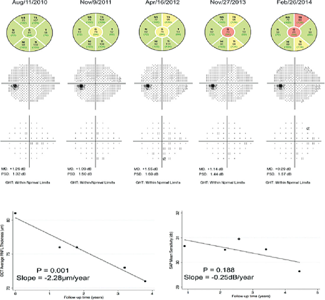 This figure shows the relative stability of serial visual field testing in a patient with mild to moderate glaucoma, whereas OCT shows structural change in the same time period.