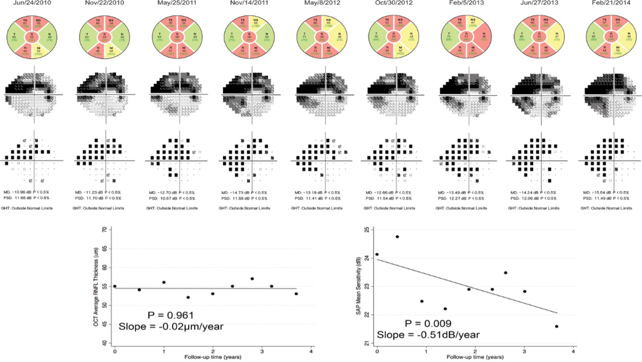 This figure shows worsening visual field studies in a patient with more advanced glaucoma over time, whereas OCT does not show comparable change in the same time period.