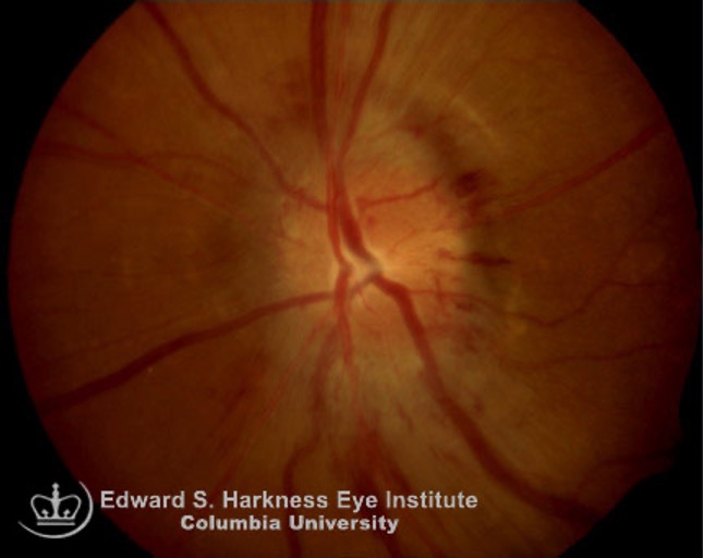 Fig. 4. Diabetic papillopathy, pictured here, is an atypical form of NAION causing no physical symptoms. 