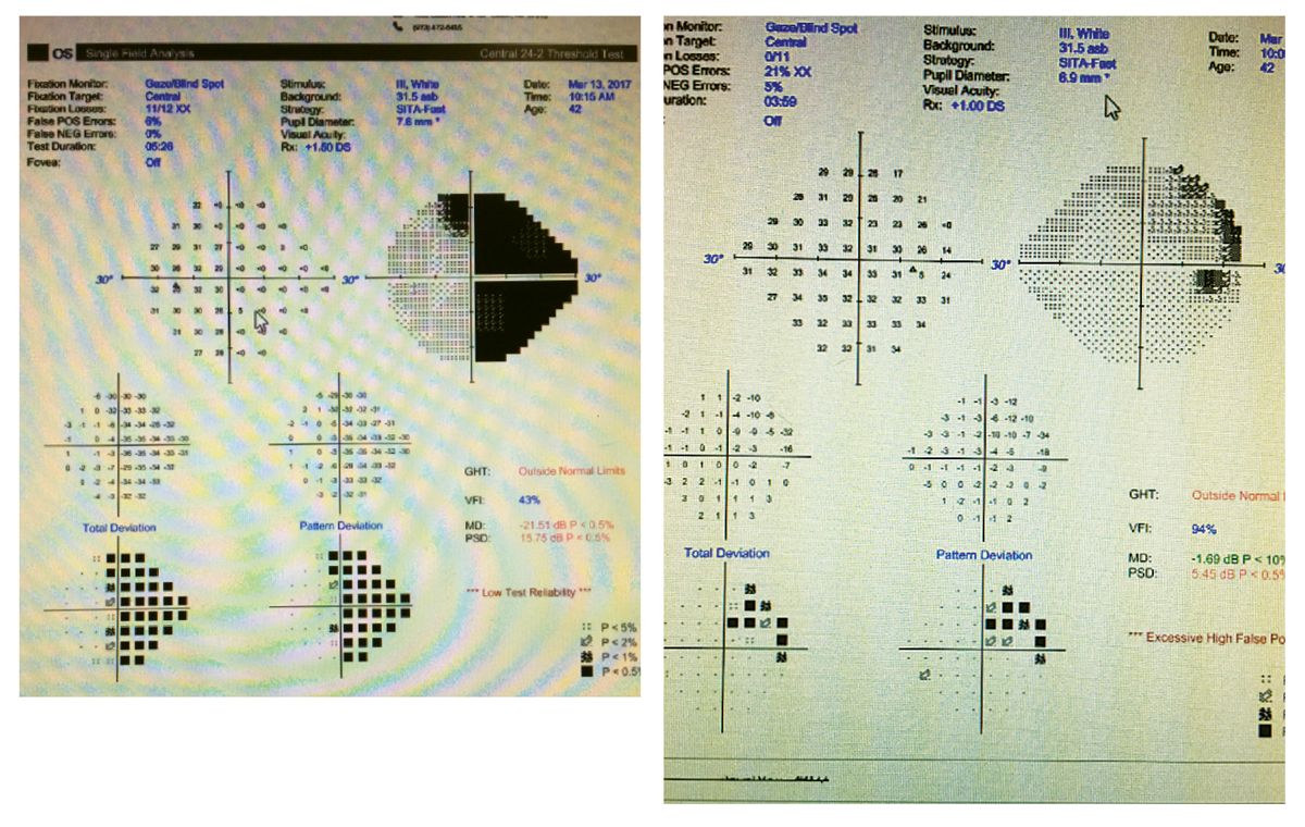 Partial non-congruous right hemianopia in a patient with relapsing-remitting MS.