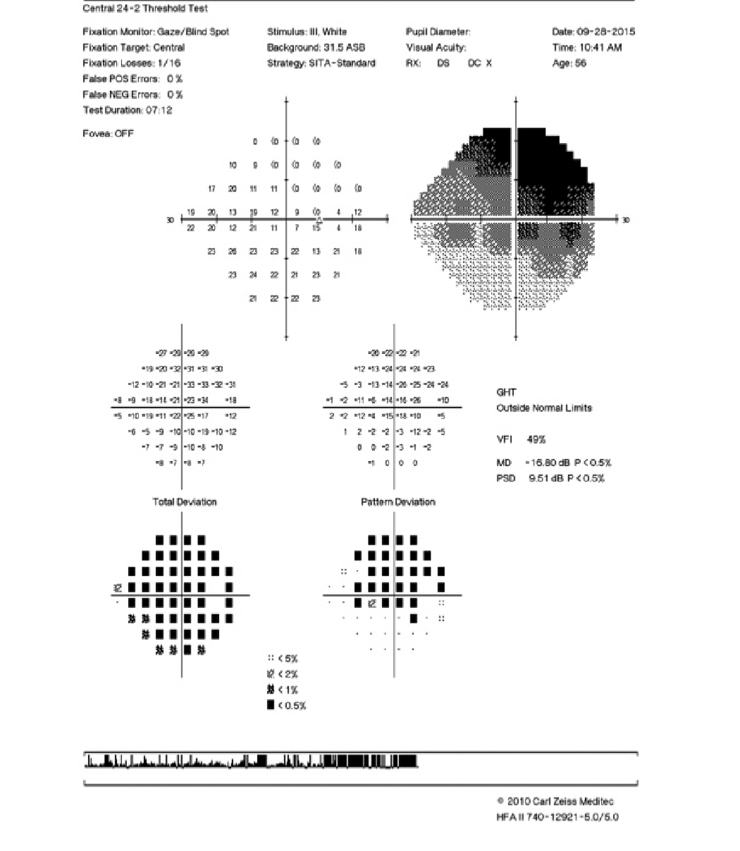 Incomplete superior visual field scotoma involving fixation.