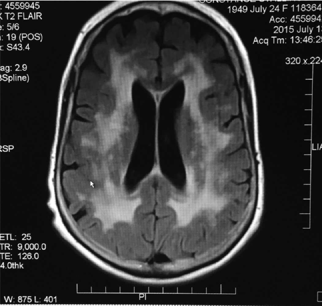 Axial MRI T2 FLAIR showing confluent white matter lesions representing demyelination from leukoencephalopathy.