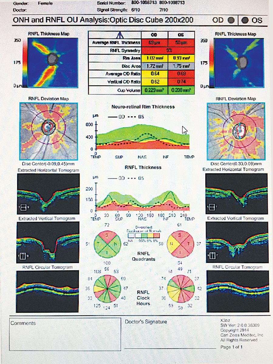 Bilateral retinal nerve fiber loss OU in a patient with MS without a history of ON.