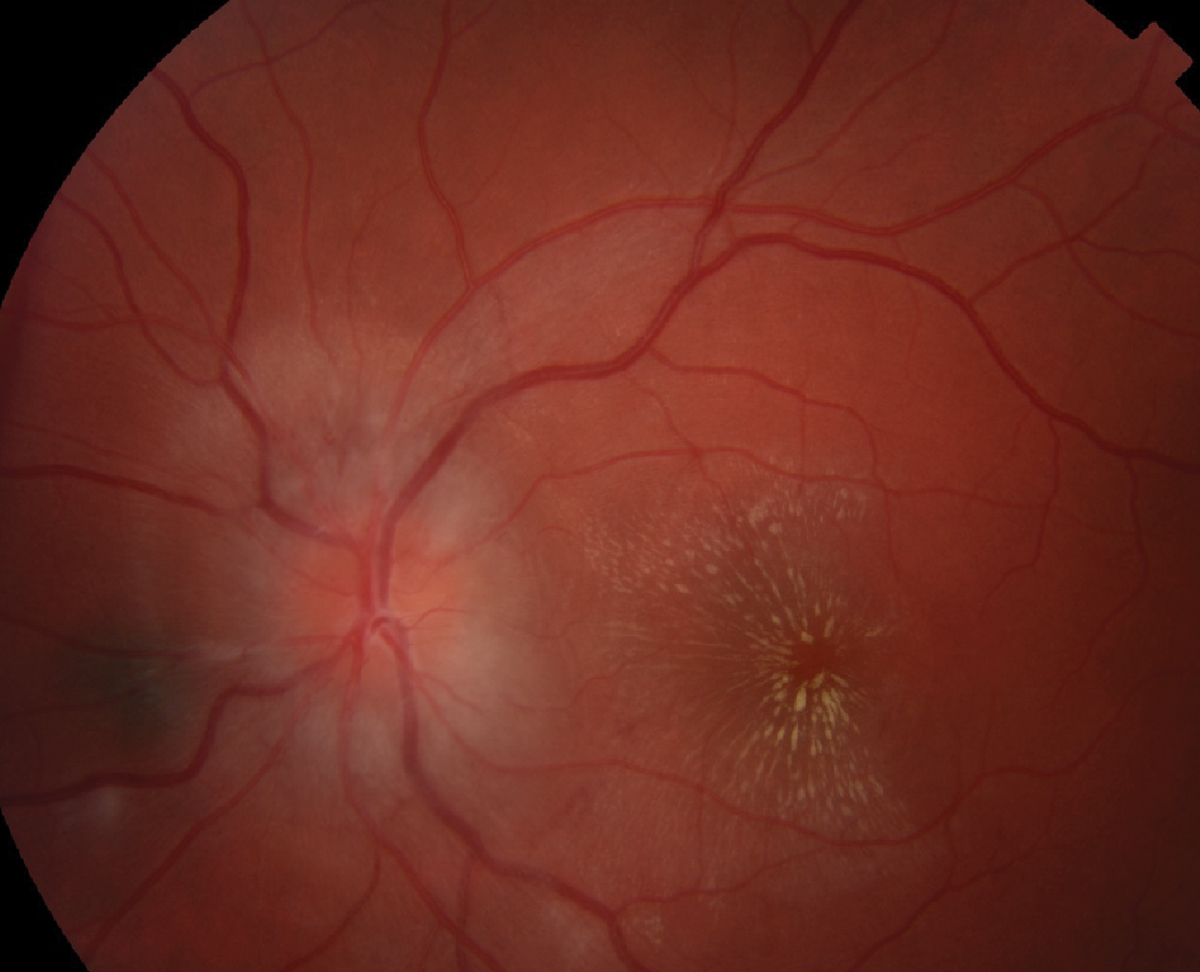 Fig. 3. Topcon fundus photo of the posterior pole of the left eye.