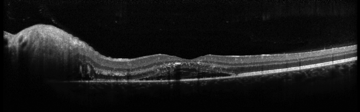 Fig. 4. Heidelberg OCT of the left macula.