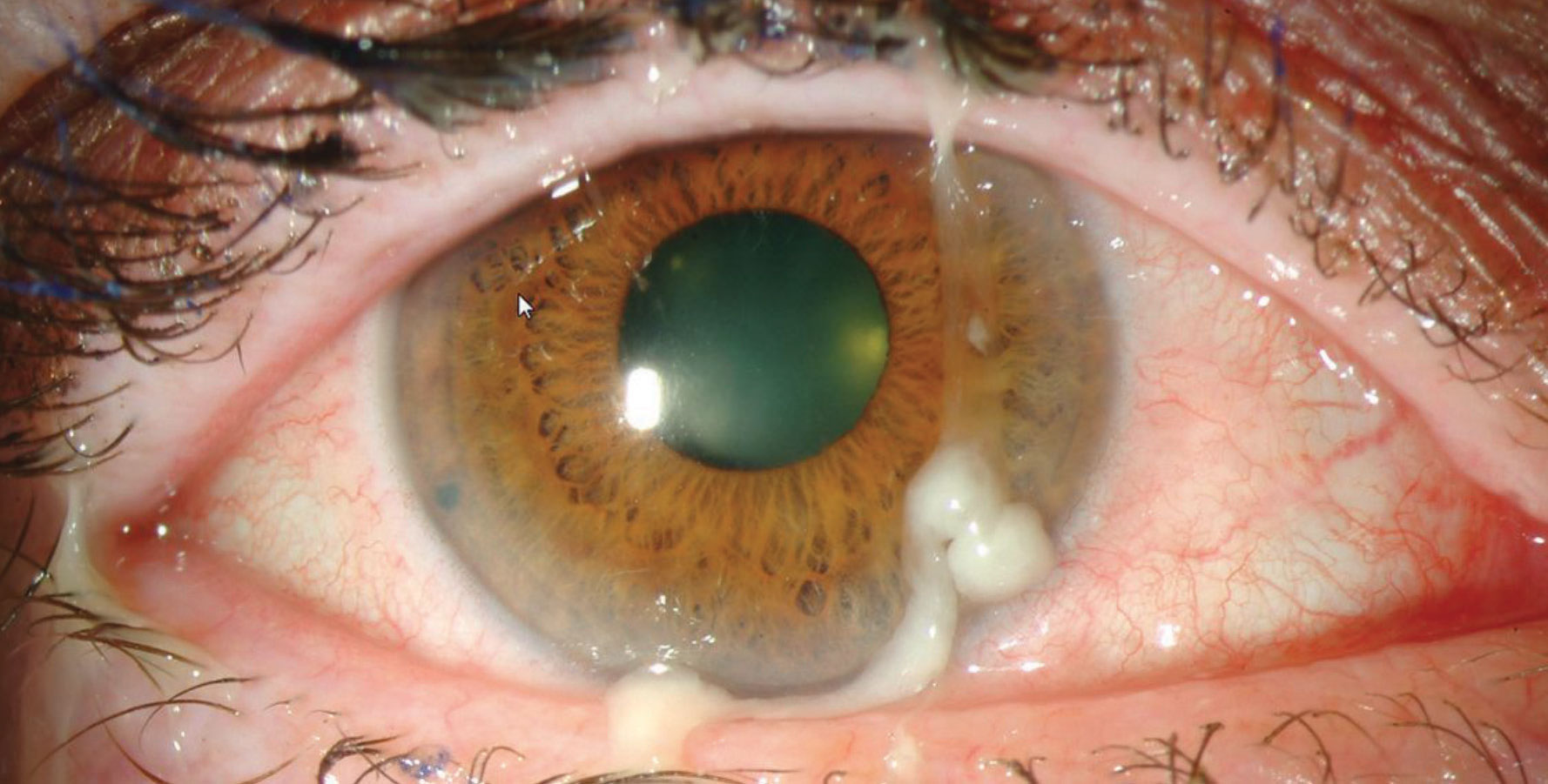 Lesson Conjunctivitis Know Your Differentials