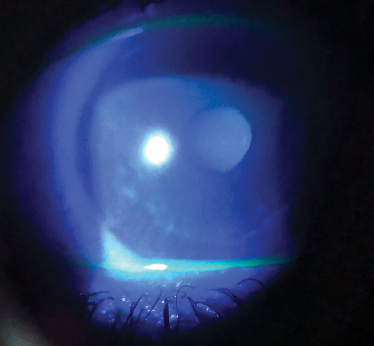 Dry eye in a patient with melanoma taking chemotherapeutic medications.