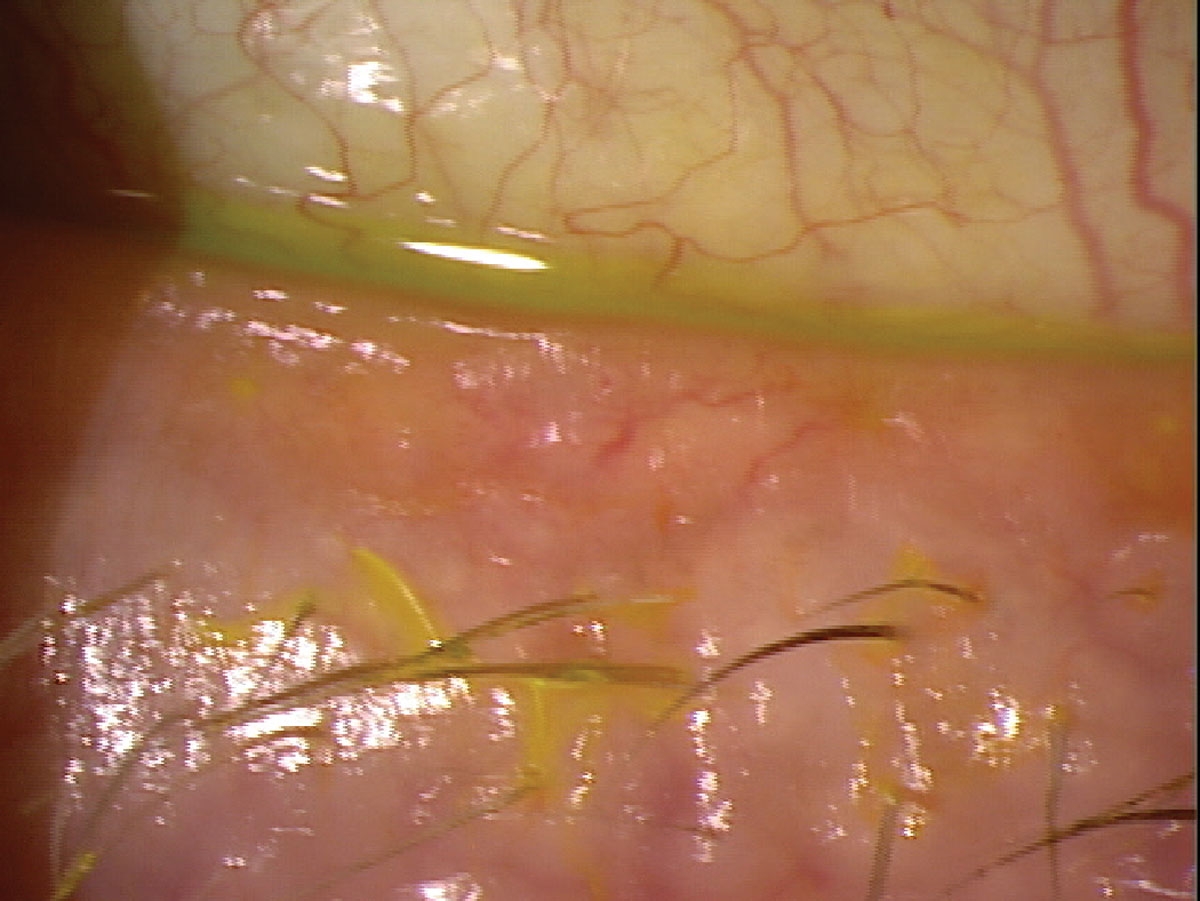 A polypharmacy patient with dryness associated with meibomian gland dysfunction.