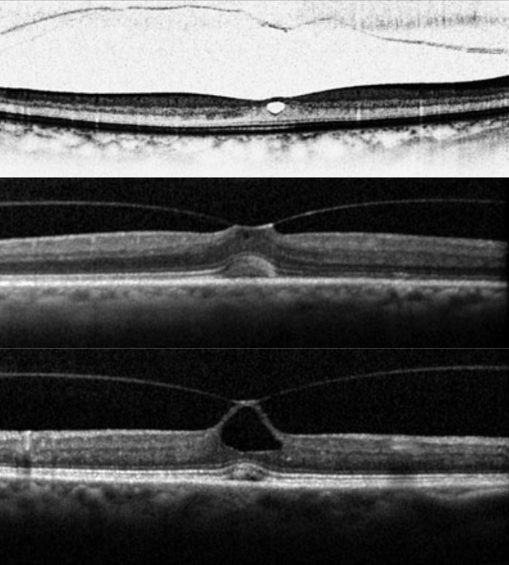 In the first few months of anti-VEGF treatment, nAMD patients should be monitored for the possibility of vitreomacular interface changes.