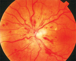 The treatment burden for anti-VEGF in eyes with CRVO over three years was an average of 18 injections at 26 visits.