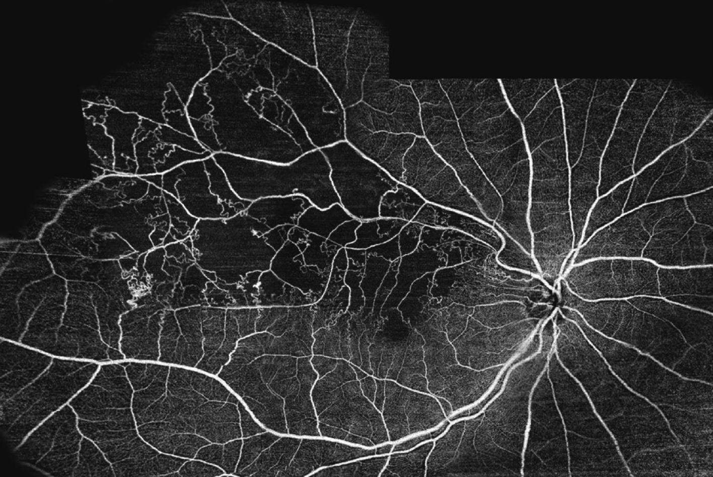 Swept-source OCT-A is a comparable, noninvasive alternative to fluorescein angiography that may save time and improve patient comfort.