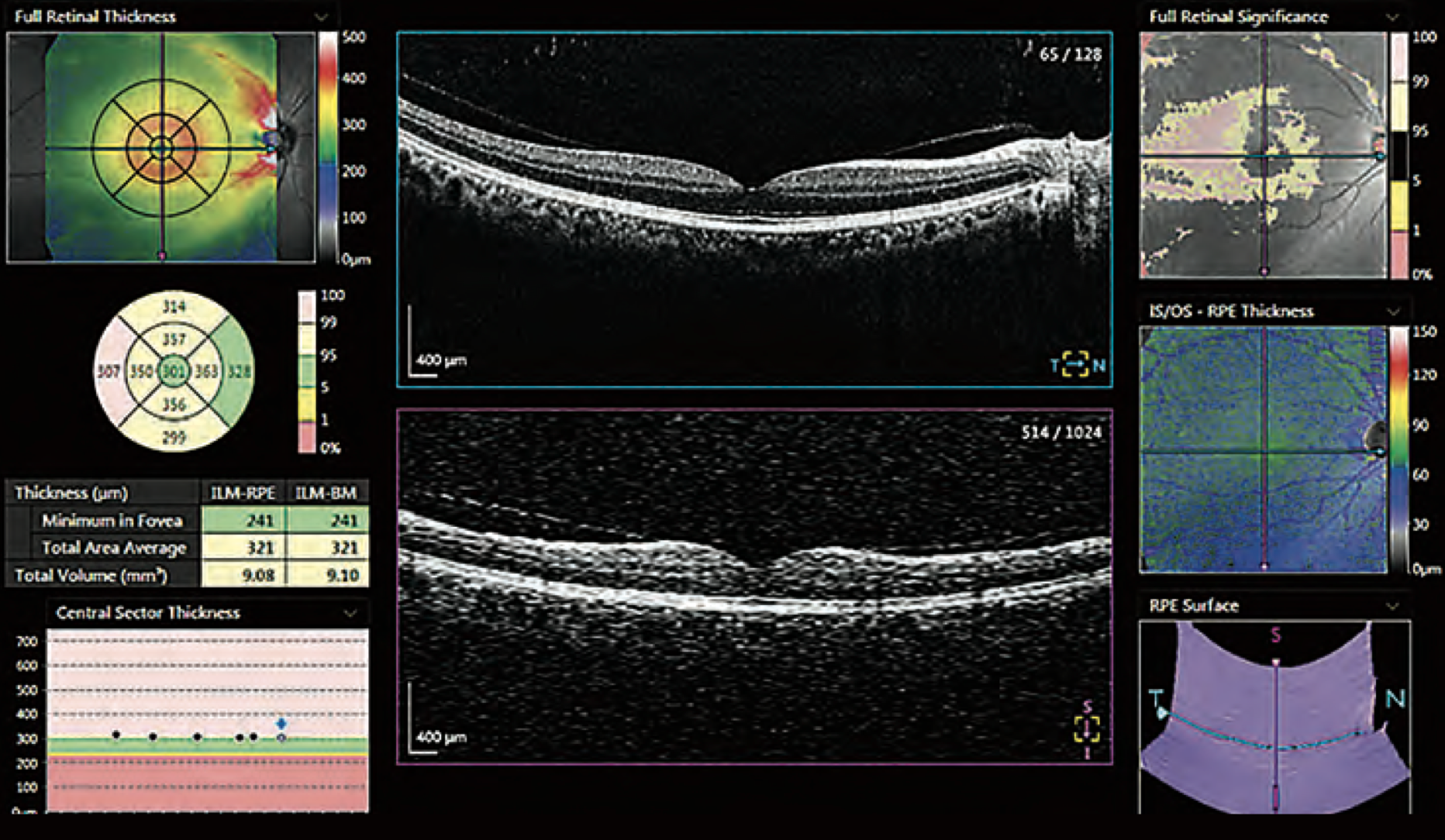 This study identified a few advantages of using total retinal thickness over RNFLT for detecting glaucoma.