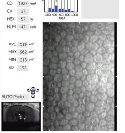 Study shows there is a significant relationship between cell size and duration of diabetic with age variable control.