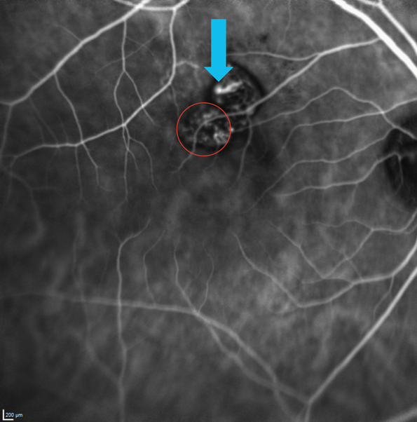 Asian patients have a higher prevalence of polypoidal choroidal vasculopathy, making fellow-eye involvement in nAMD less likely than in Caucasians. Their progression biomarkers appear differently, and experts recommend close monitoring for exudation.