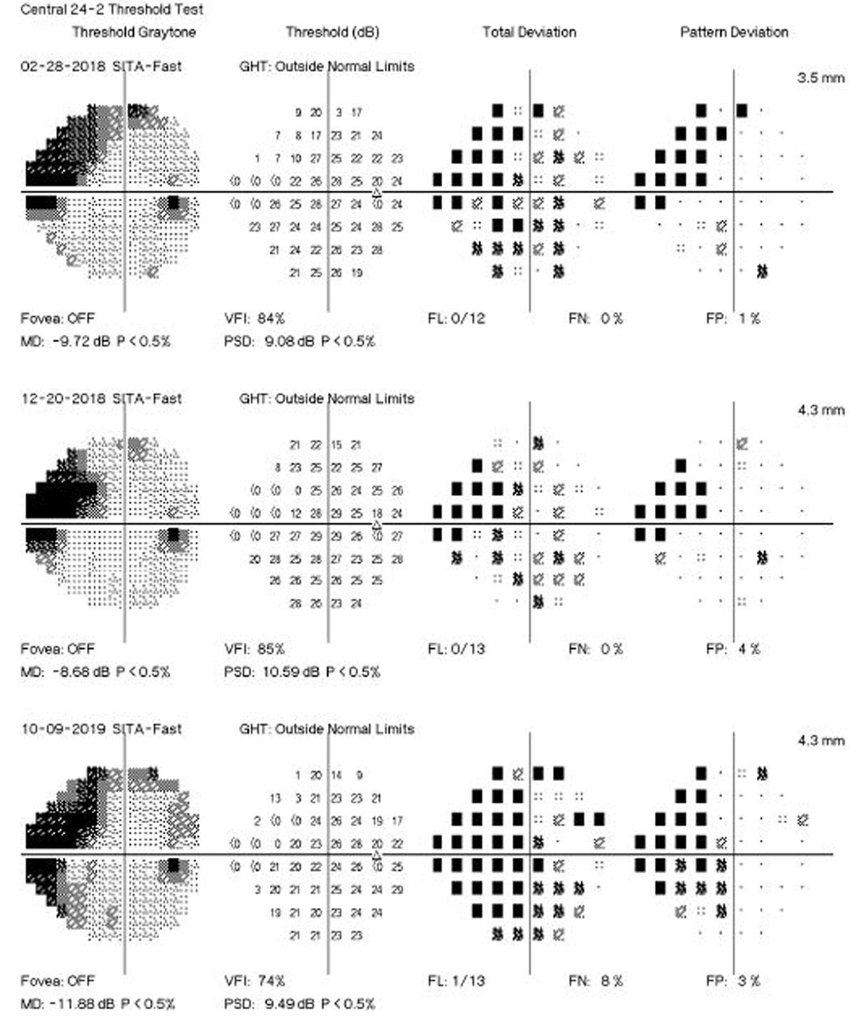 Genetic screening was found to help determine glaucoma progression in the early stage of the disease.