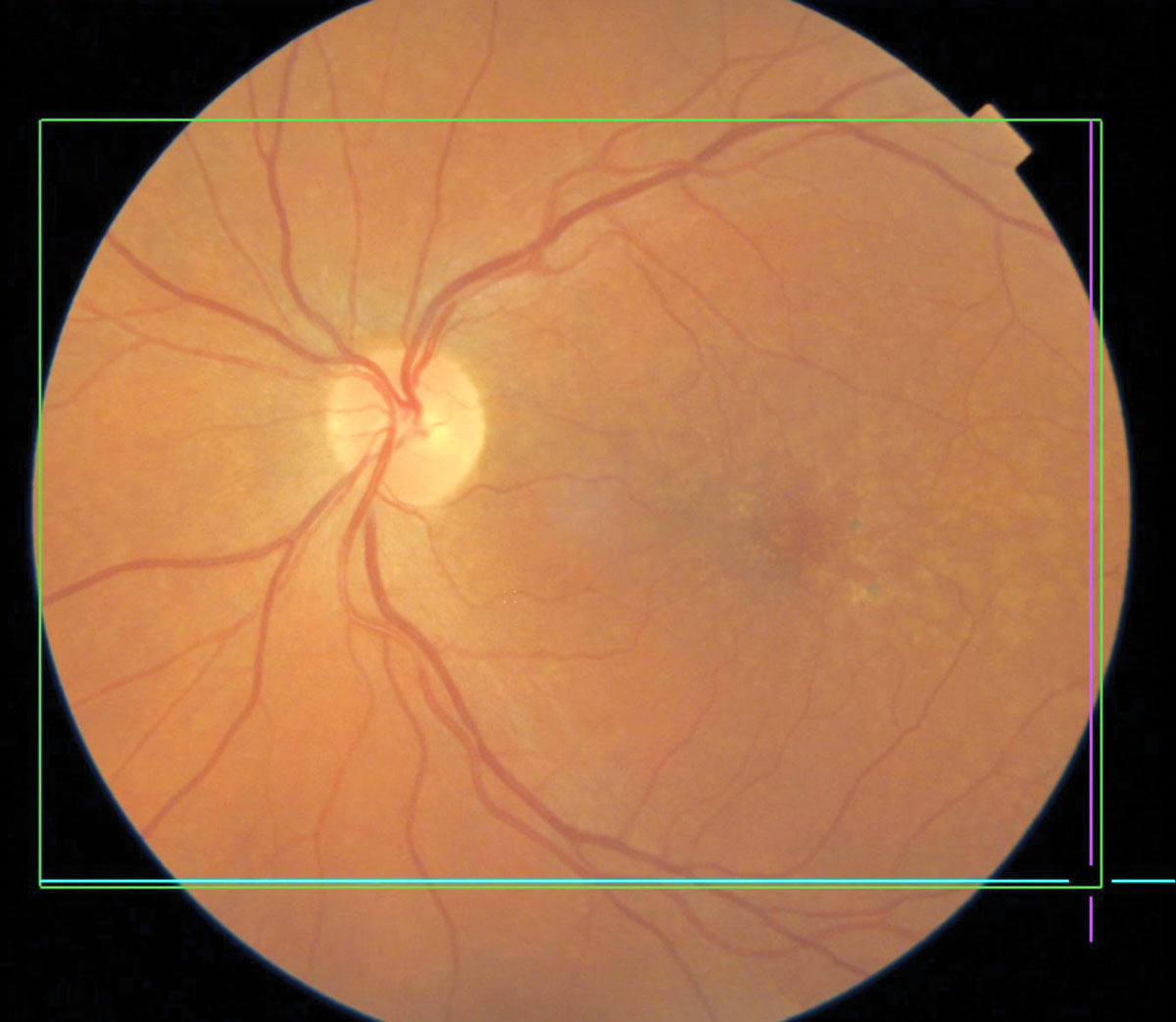 MNV lesion growth is detectable on OCTA, which may help guide treatment for these patients.