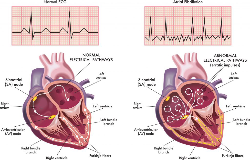 Cardiovascular disease, particularly atrial fibrillation, is significantly associated with glaucoma development. Experts recommend glaucoma screening for these patients.