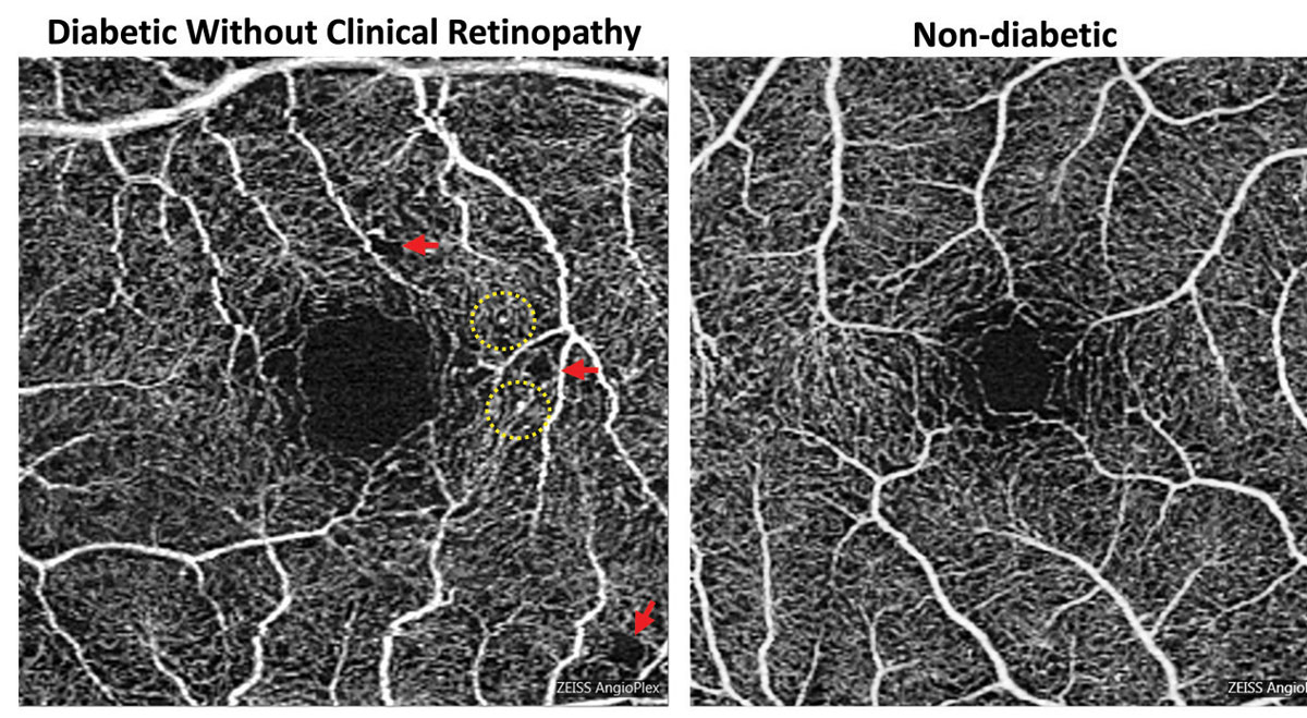 Foveal enlargement and perifoveal capillary remodeling detected with OCT-A in a diabetic eye without funduscopically visible diabetic retinopathy. Red arrows point to subtle areas of capillary nonperfusion, while yellow circles highlight microaneurysms.