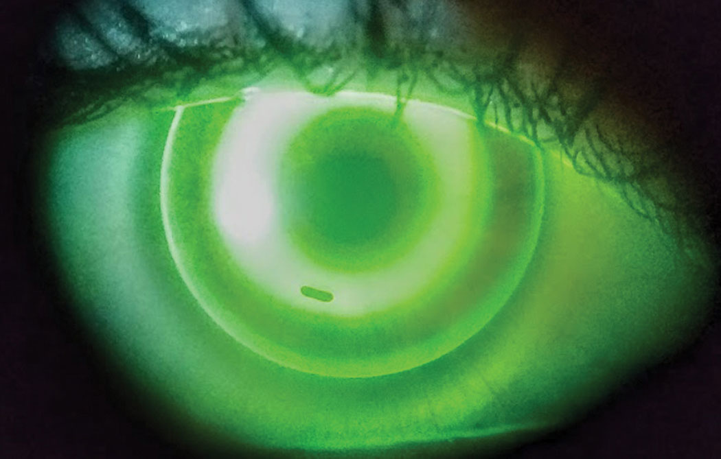 Taking a baseline AL measurement may help determine future axial elongation in ortho-K wearers.